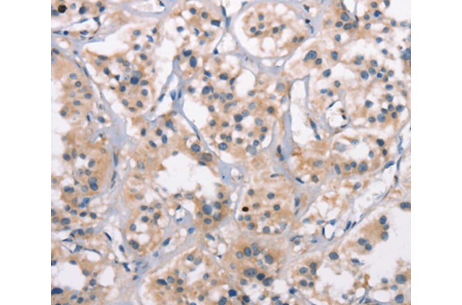 Immunohistochemistry - CTAG1A/B Antibody from Signalway Antibody (37512) - Antibodies.com