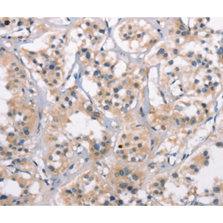 Immunohistochemistry - CTAG1A/B Antibody from Signalway Antibody (37512) - Antibodies.com