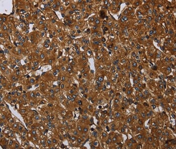 Immunohistochemical analysis of paraffin-embedded Human prostate cancer tissue using #37694 at dilution 1/20.