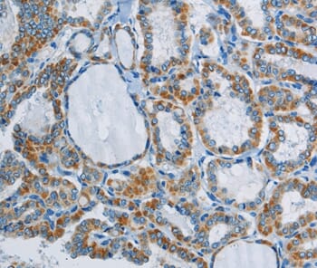 Immunohistochemical analysis of paraffin-embedded Human thyroid cancer tissue using #37819 at dilution 1/40.