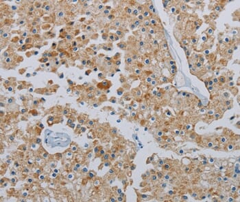 Immunohistochemical analysis of paraffin-embedded Human prostate cancer tissue using #37819 at dilution 1/40.