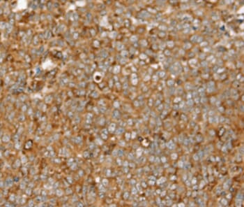 Immunohistochemical analysis of paraffin-embedded Human ovarian cancer tissue using #37923 at dilution 1/30.
