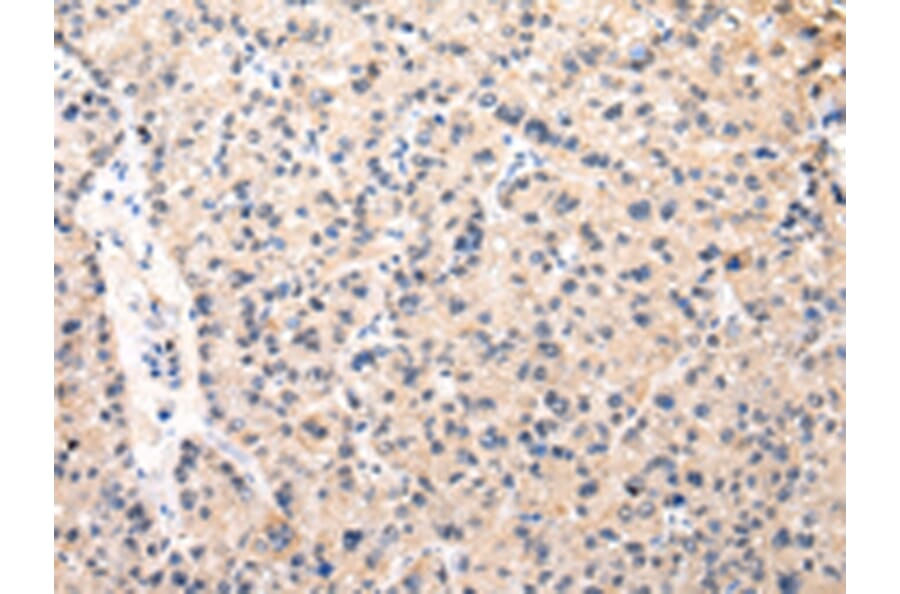 Immunohistochemistry - MUC1 (NT) Antibody from Signalway Antibody (43221) - Antibodies.com