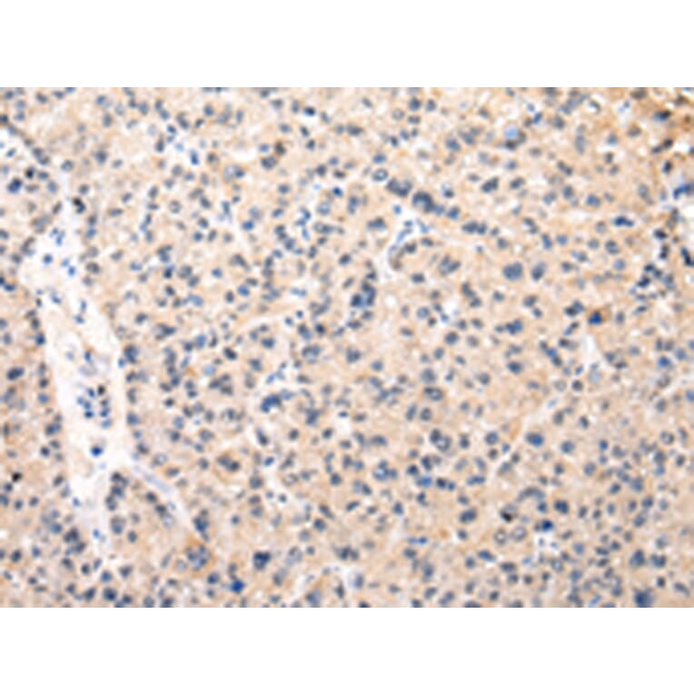 Immunohistochemistry - MUC1 (NT) Antibody from Signalway Antibody (43221) - Antibodies.com