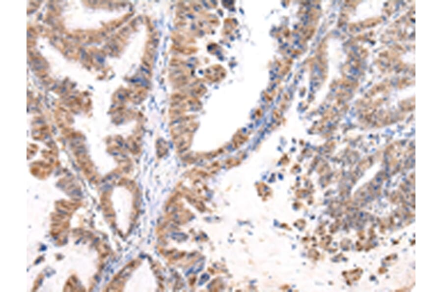 Immunohistochemistry - MUC1 (NT) Antibody from Signalway Antibody (43221) - Antibodies.com
