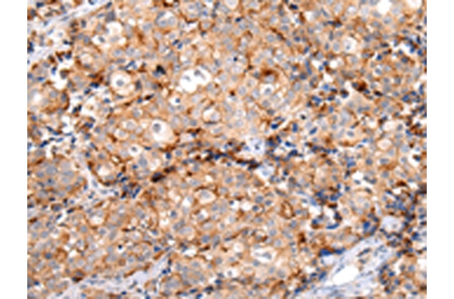 Immunohistochemistry - MUC1 (CT) Antibody from Signalway Antibody (43222) - Antibodies.com