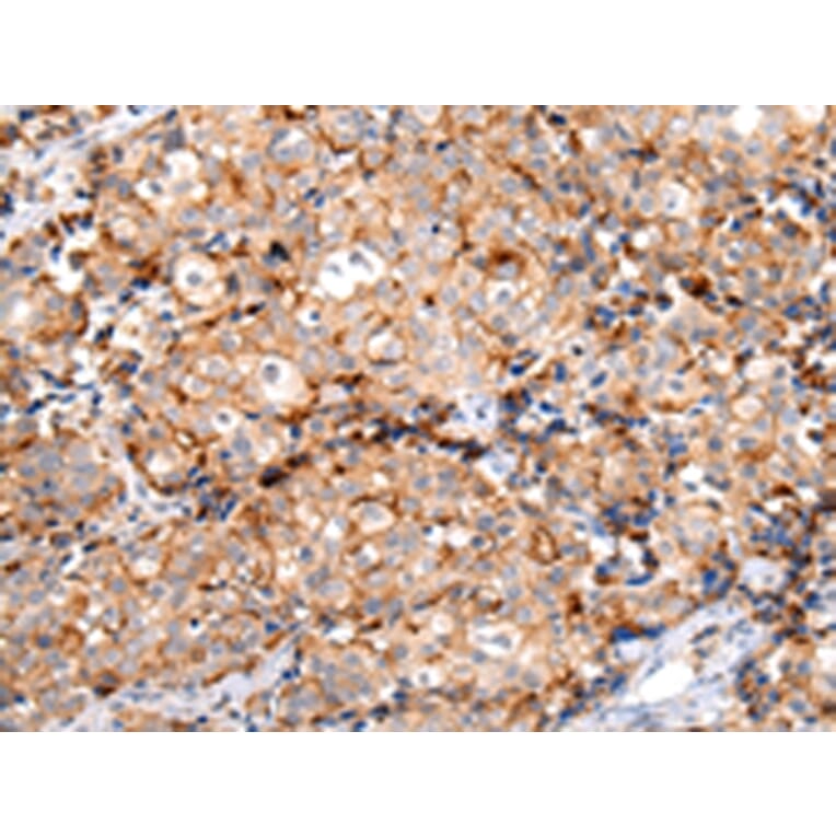 Immunohistochemistry - MUC1 (CT) Antibody from Signalway Antibody (43222) - Antibodies.com