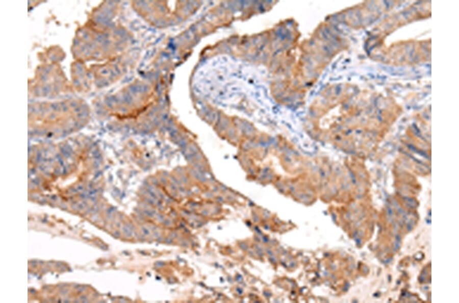 Immunohistochemistry - MUC1 (CT) Antibody from Signalway Antibody (43222) - Antibodies.com