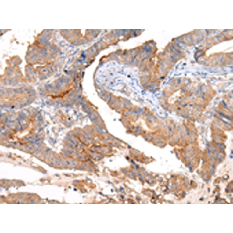 Immunohistochemistry - MUC1 (CT) Antibody from Signalway Antibody (43222) - Antibodies.com