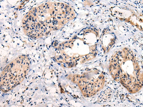 The image on the left is immunohistochemistry of paraffin-embedded Human cervical cancer tissue using C16orf45 Antibody at dilution 1/45, on the right is treated with synthetic peptide. (Original magnification: x200)