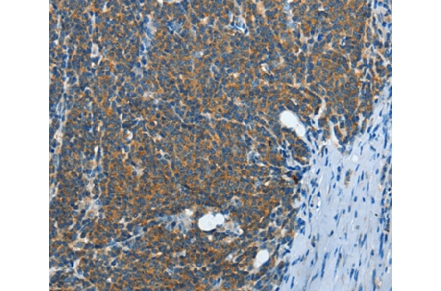 Immunohistochemistry - IL13RA2 Antibody from Signalway Antibody (35601) - Antibodies.com
