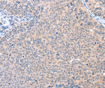 Immunohistochemical analysis of paraffin-embedded Human cervical cancer tissue using #36002 at dilution 1/25.