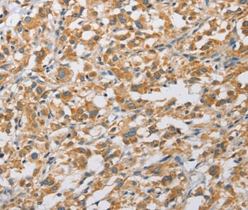 Immunohistochemical analysis of paraffin-embedded Human thyroid cancer tissue using #36130 at dilution 1/25.