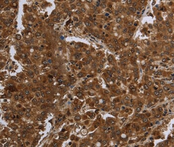 Immunohistochemical analysis of paraffin-embedded Human liver cancer tissue using #36468 at dilution 1/60.