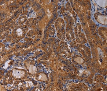 Immunohistochemical analysis of paraffin-embedded Human thyroid cancer tissue using #36596 at dilution 1/60.
