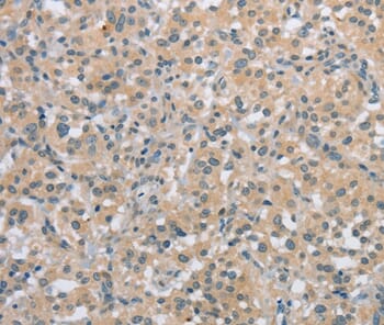 Immunohistochemical analysis of paraffin-embedded Human thyroid cancer tissue using #36833 at dilution 1/20.