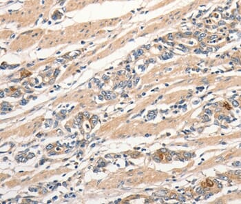 Immunohistochemical analysis of paraffin-embedded Human gastric cancer tissue using #37034 at dilution 1/30.