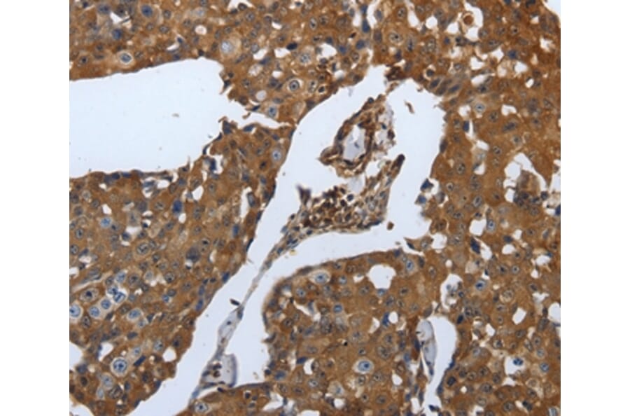 Immunohistochemistry - SLC34A2 Antibody from Signalway Antibody (37035) - Antibodies.com