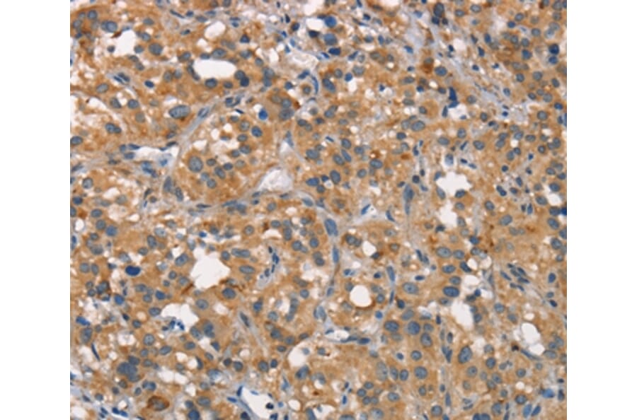 Immunohistochemistry - CEACAM6 Antibody from Signalway Antibody (37163) - Antibodies.com