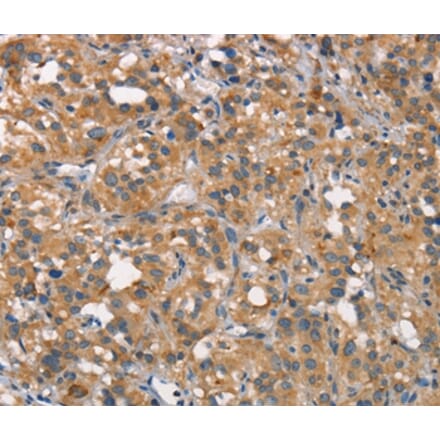 Immunohistochemistry - CEACAM6 Antibody from Signalway Antibody (37163) - Antibodies.com