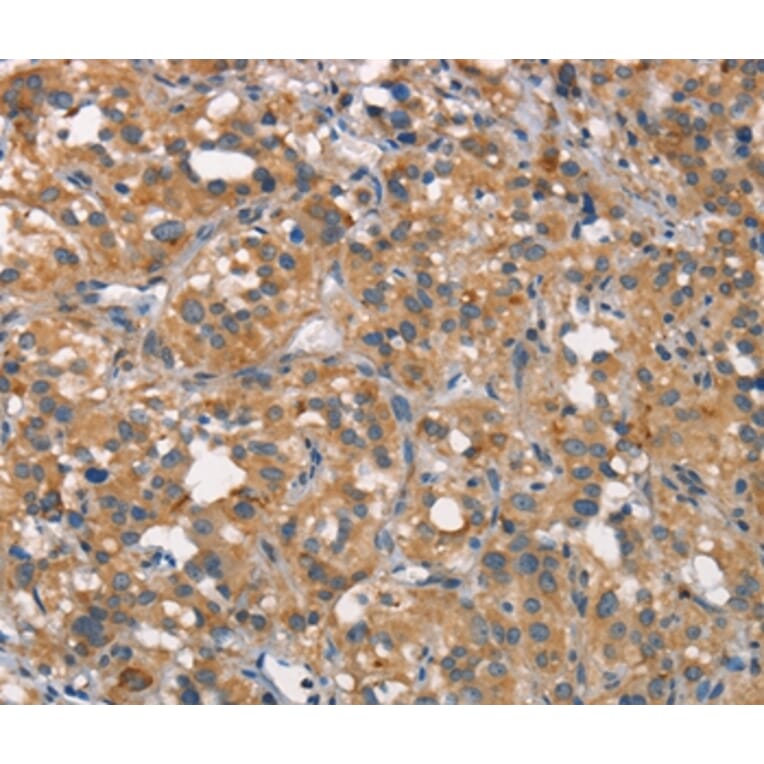 Immunohistochemistry - CEACAM6 Antibody from Signalway Antibody (37163) - Antibodies.com