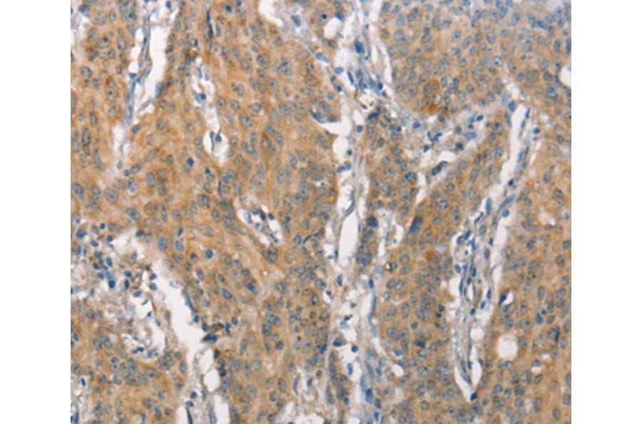 Immunohistochemistry - CEACAM6 Antibody from Signalway Antibody (37163) - Antibodies.com