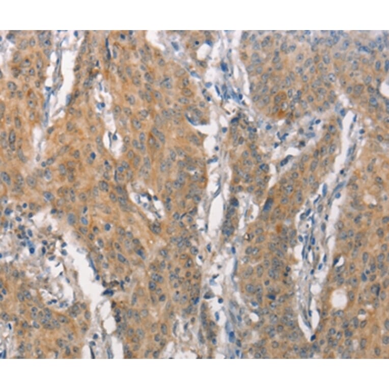 Immunohistochemistry - CEACAM6 Antibody from Signalway Antibody (37163) - Antibodies.com