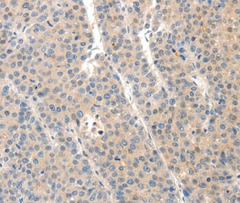 Immunohistochemical analysis of paraffin-embedded Human liver cancer tissue using #37243 at dilution 1/40.