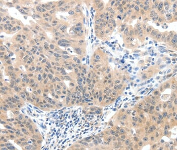 Immunohistochemical analysis of paraffin-embedded Human ovarian cancer tissue using #37243 at dilution 1/40.