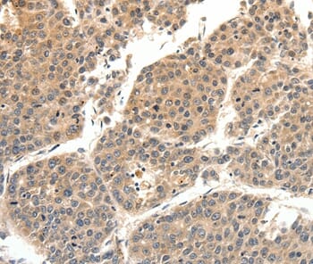 Immunohistochemical analysis of paraffin-embedded Human lung cancer tissue using #37246 at dilution 1/40.