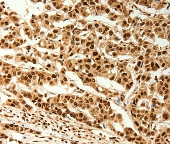 Immunohistochemical analysis of paraffin-embedded Human cervical cancer tissue using #37280 at dilution 1/80.
