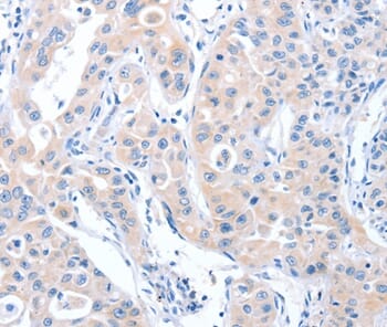 Immunohistochemical analysis of paraffin-embedded Human lung cancer tissue using #37342 at dilution 1/70.