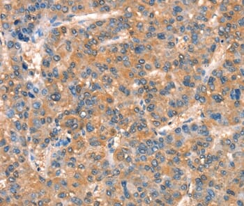 Immunohistochemical analysis of paraffin-embedded Human liver cancer tissue using #37353 at dilution 1/25.