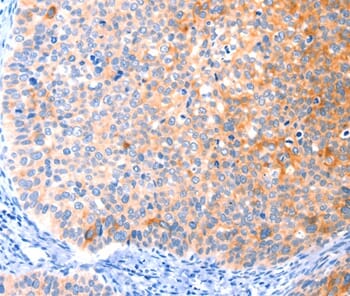 Immunohistochemical analysis of paraffin-embedded Human cervical cancer tissue using #37414 at dilution 1/50.