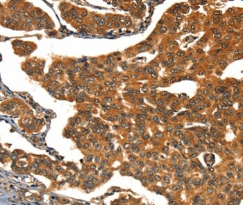 Immunohistochemical analysis of paraffin-embedded Human breast cancer tissue using #37453 at dilution 1/15.