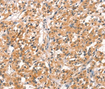Immunohistochemical analysis of paraffin-embedded Human thyroid cancer tissue using #37521 at dilution 1/30.