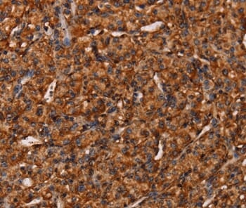 Immunohistochemical analysis of paraffin-embedded Human prostate cancer tissue using #37548 at dilution 1/40.