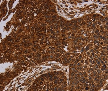 Immunohistochemical analysis of paraffin-embedded Human lung cancer tissue using #37755 at dilution 1/50.