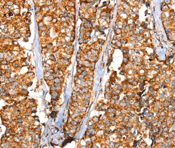 Immunohistochemical analysis of paraffin-embedded Human breast cancer tissue using #37937 at dilution 1/35.