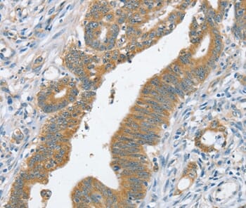 Immunohistochemical analysis of paraffin-embedded Human colorectal cancer tissue using #37941 at dilution 1/20.