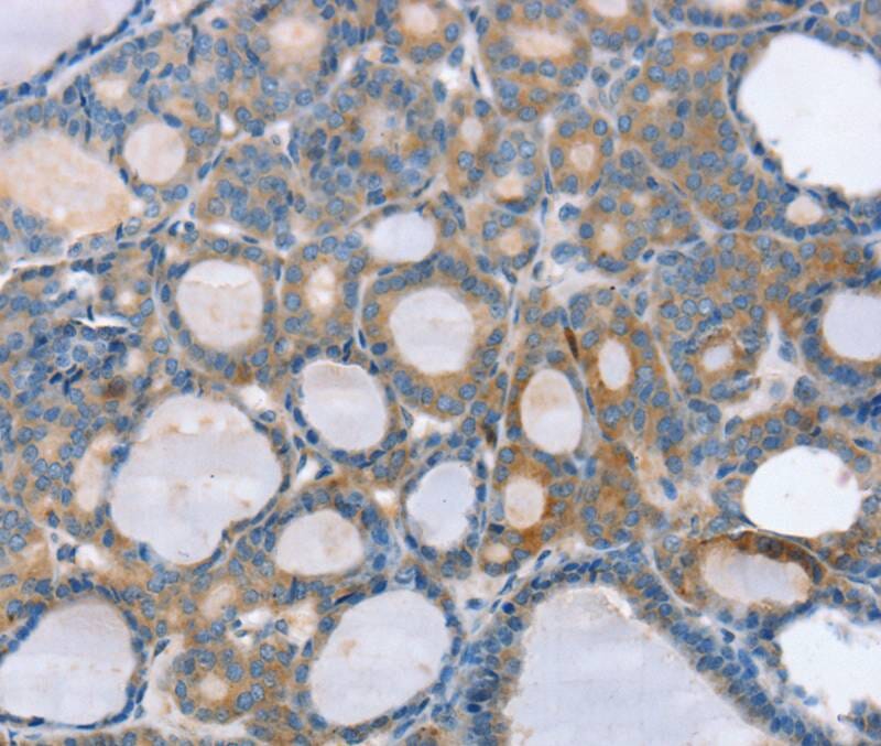 Immunohistochemical analysis of paraffin-embedded Human thyroid cancer tissue using #40107 at dilution 1/25.