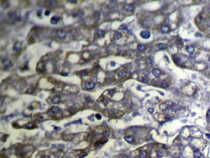 Immunohistochemical analysis of paraffin-embedded Human Liver cancer tissue using #40109 at dilution 1/100.