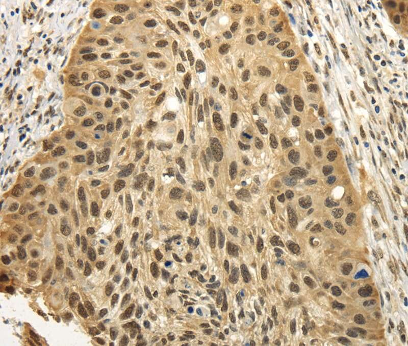 Immunohistochemical analysis of paraffin-embedded Human oesophagus cancer tissue using #40136 at dilution 1/25.