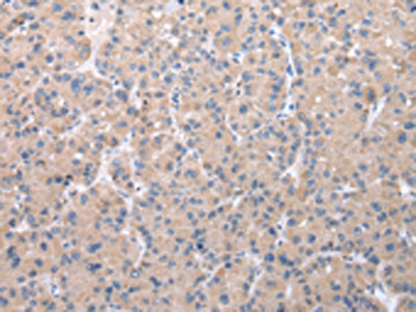 Immunohistochemical analysis of paraffin-embedded Human liver cancer tissue using #42868 at dilution 1/30,