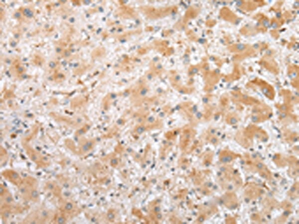 Immunohistochemical analysis of paraffin-embedded Human liver cancer tissue using #42952 at dilution 1/25.