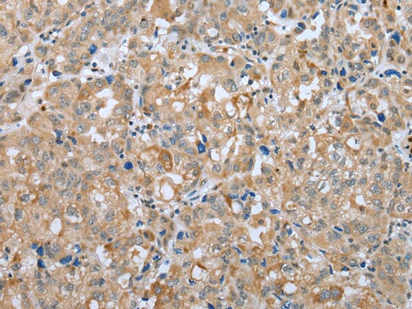 Immunohistochemical analysis of paraffin-embedded Human ovarian cancer tissue using #42975 at dilution 1/25,