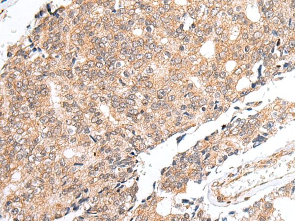 Immunohistochemical analysis of paraffin-embedded Human prostate cancer tissue using #42978 at dilution 1/40,