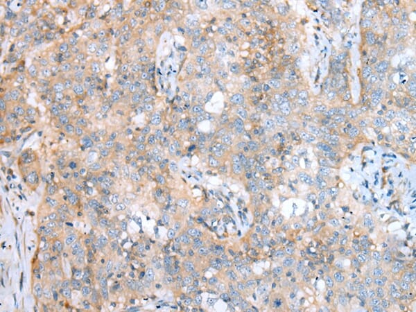 Immunohistochemical analysis of paraffin-embedded Human oesophagus cancer tissue using #43294 at dilution 1/20,