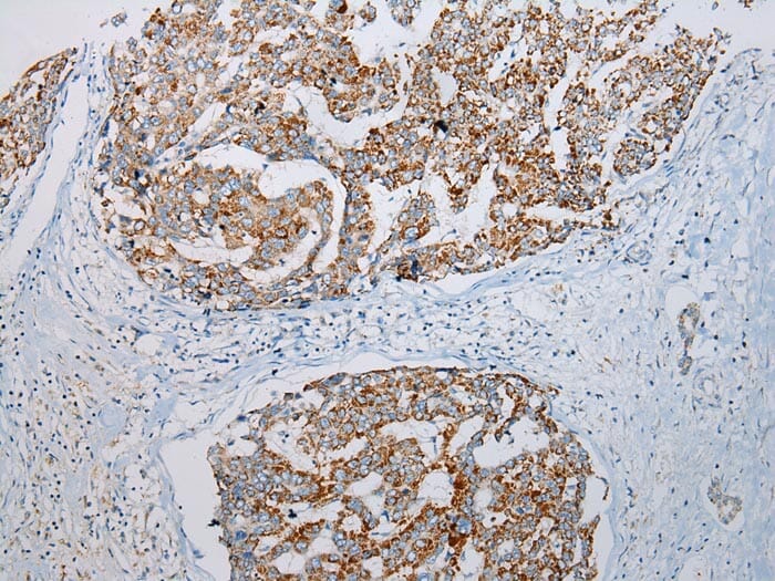 Immunohistochemical analysis of paraffin-embedded Human Liver cancer tissue using #43307 at dilution 1/200.