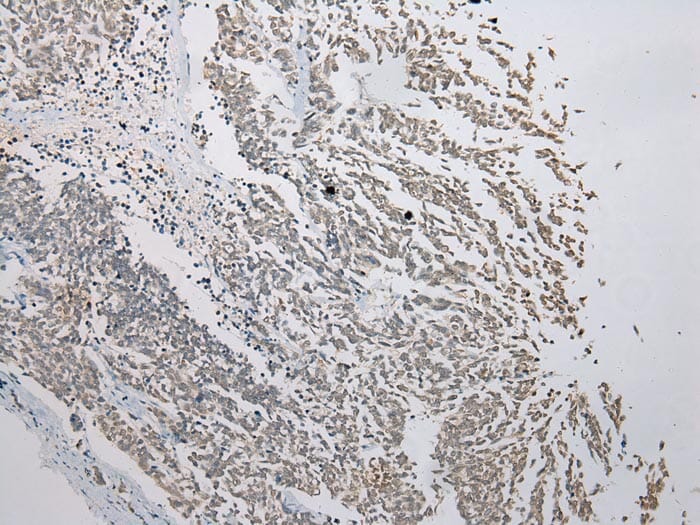 Immunohistochemical analysis of paraffin-embedded Human Lung cancer tissue using #43371 at dilution 1/200.